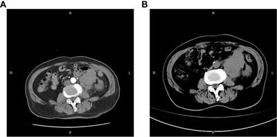 Cardiac infarction caused by PD-1 inhibitor during small cell neuroendocrine carcinoma of the ureter treatment: A case report